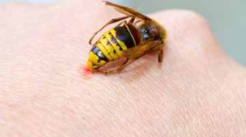 Что делать если опухла и болит рука от укуса осы