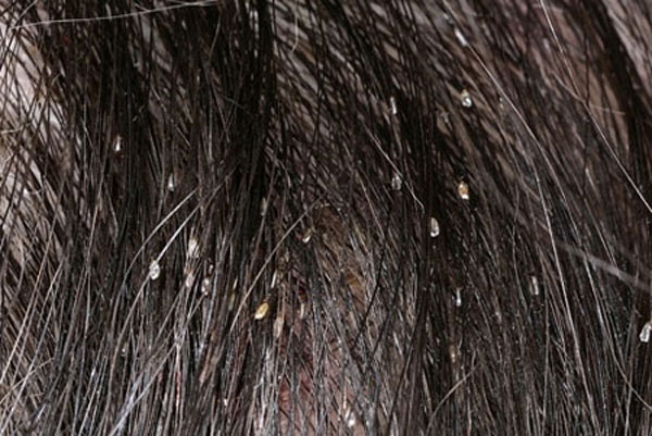 Как вычистить гнид из волос